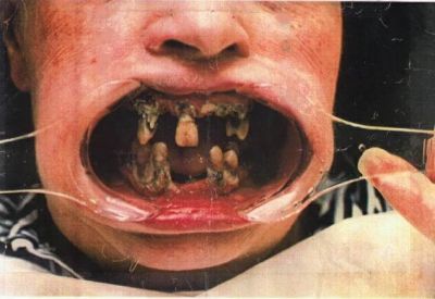 http://www.dudelire.com/images/gal/dd7re49-mauvaise-dentition.jpg